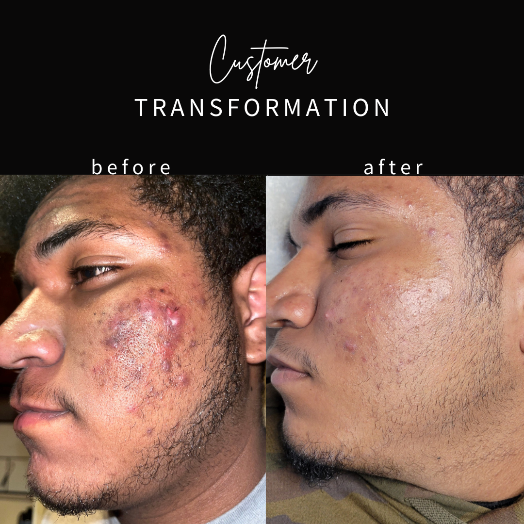 http://www.montarboskincare.com/uploads/3/0/0/6/30066401/brendas-son-before-and-after_orig.png
